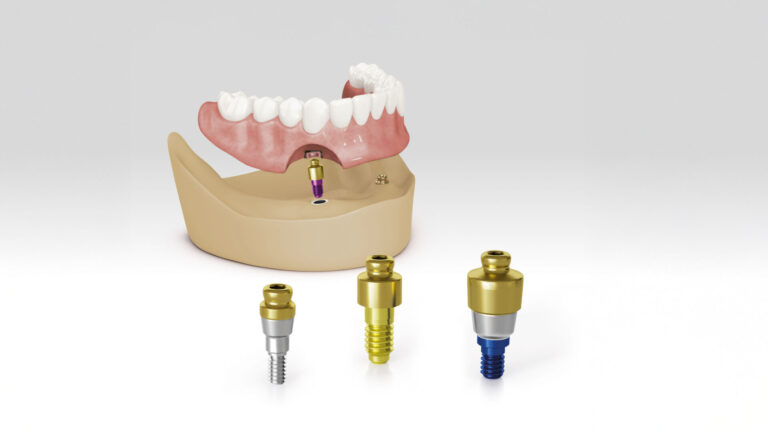 Prothesen sicher auf Implantaten fixieren